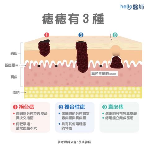 痣怎麼來的|痣形成的原因？痣長毛、痣變多變大是痣病變？5招判。